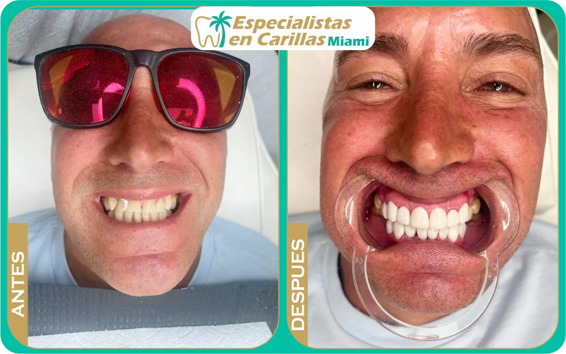 Carillas de resina indirecta aplicadas por odontólogos expertos en Miami.